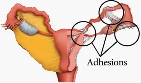postoperative-adhesions postoperative-adhesions