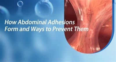 Hoe abdominale verklevingen ontstaan ​​en manieren om ze te voorkomen